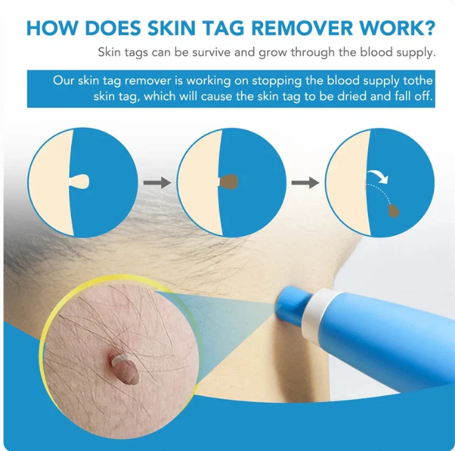 Double Headed Pen Set Auto Skin Tag Remover Kit