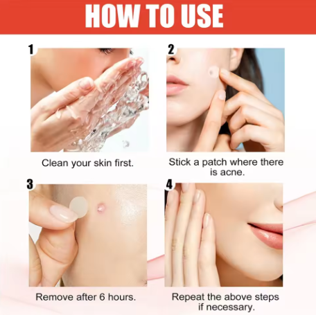 144 Pcs Acne Pimple Patches – Invisible Healing Spot Stickers